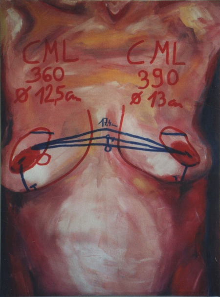 weiblicher Torso mit Markierungen vor einer Schönheitsoperation